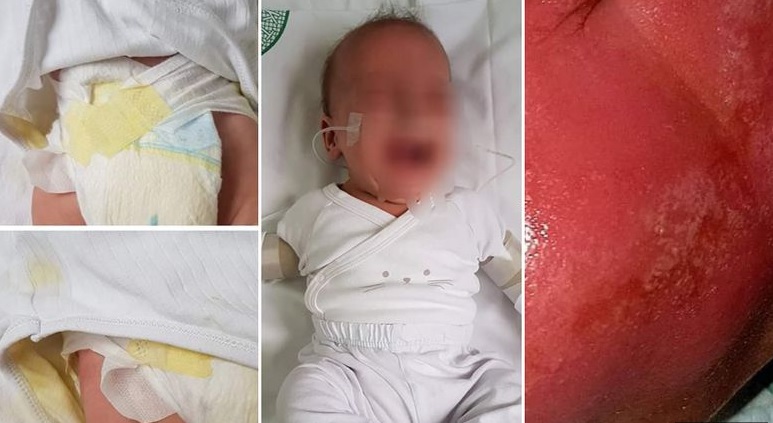 Nove pritužbe na liječenje: Objavljene slike beba, pojavile su im se rane u području pelena; Počeli smo dobivati prijetnje smrću, pa smo kao bolnica sve prijavili policiji