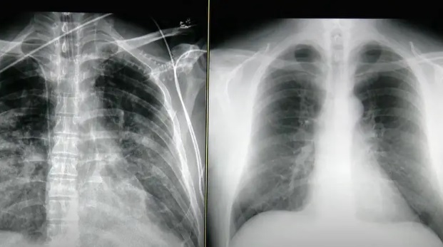 Ovako izgledaju pluća pacijenta iz Zagreba koji ima korona virus