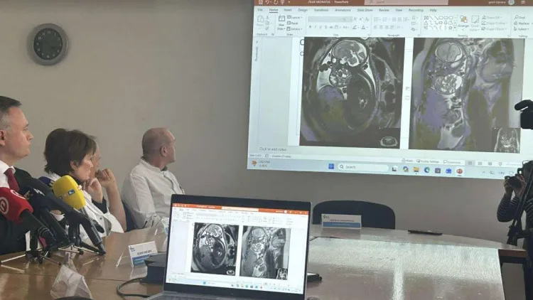 Nevjerojatan zahvat u KBC-u Zagreb: Liječnici carskim rezom napola izvadili bebu kako bi odstranili tumor koji joj je ugrožavao život